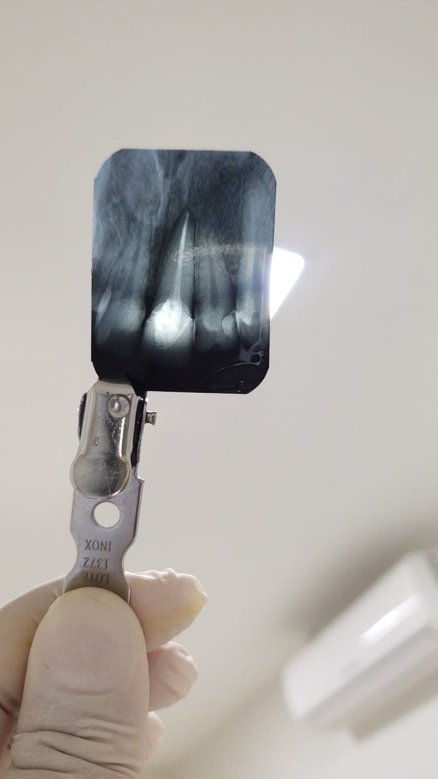 Radiografia periapical sendo analisada — exame complementar utilizado na avaliação odontológica