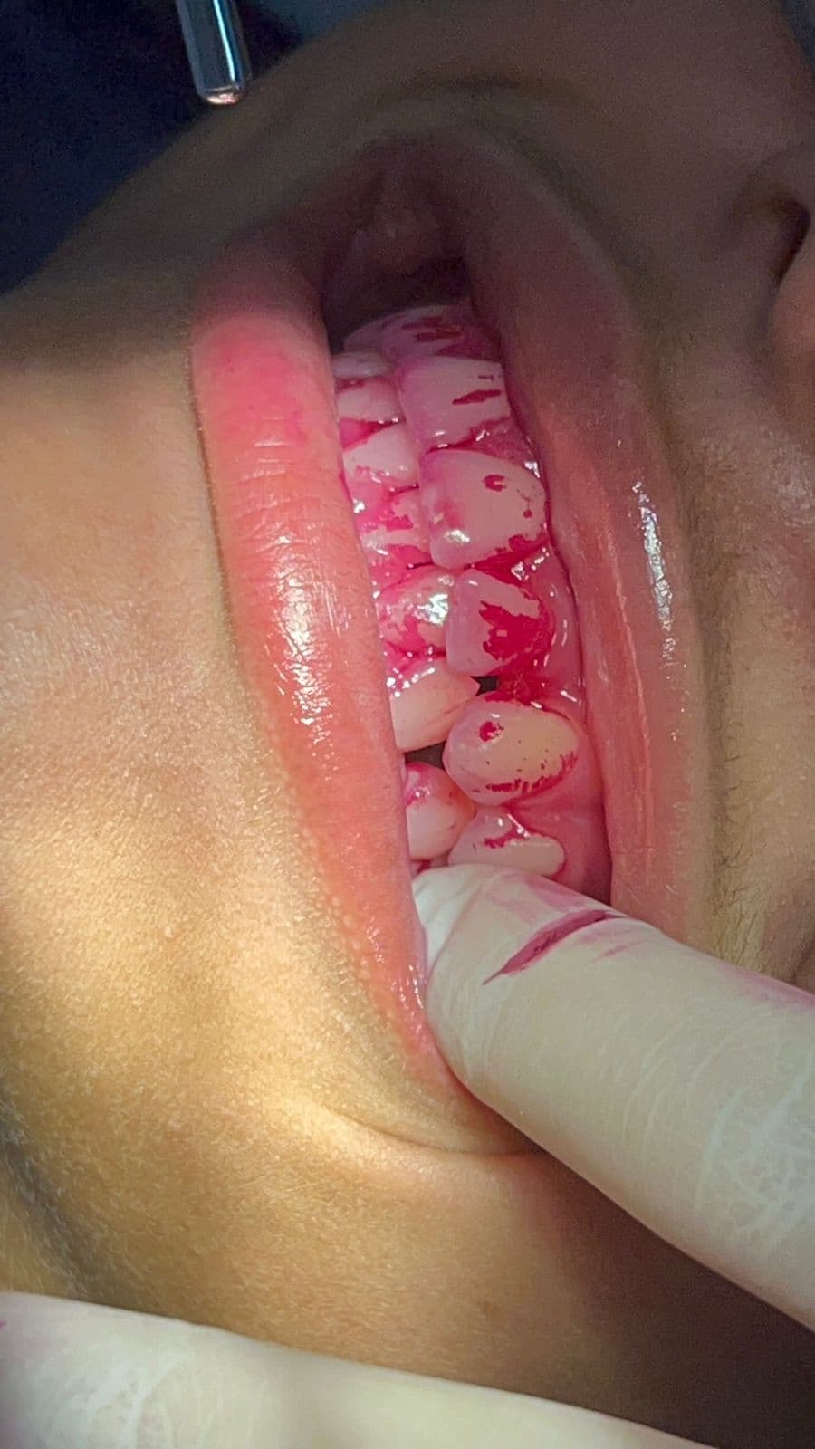 Procedimento de limpeza dental realizado pela Dra. Ana Beatriz — evidenciação de placa bacteriana para higiene orientada