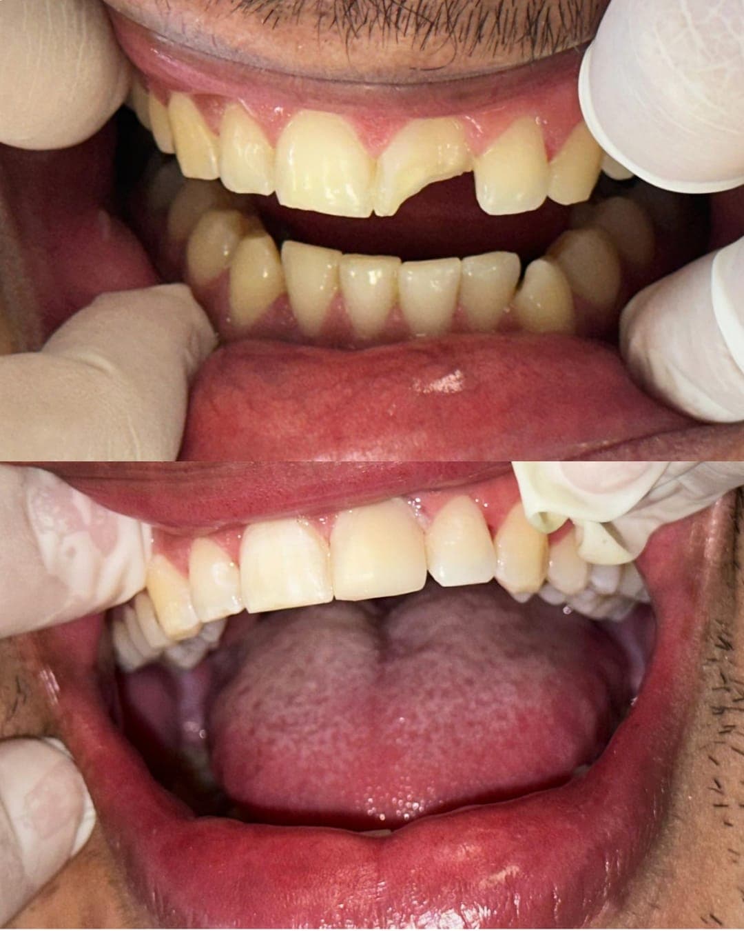 Antes e depois de restauração dental — recuperação estética e funcional dos dentes anteriores